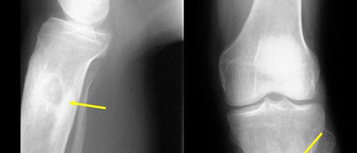Признаки остеомиелита на рентгенограмме
